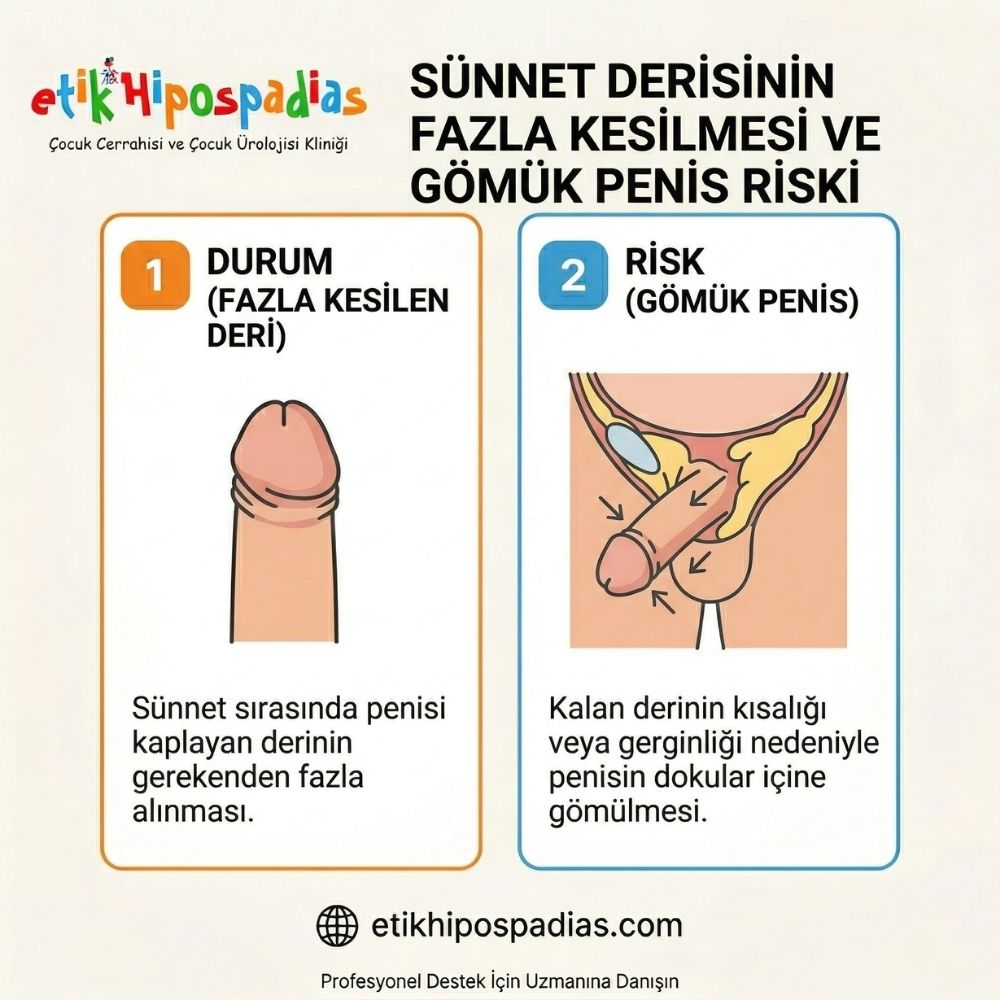  sÃ¼nnet derisinin fazla kesilmesi nasÄ±l anlaÅŸÄ±lÄ±r